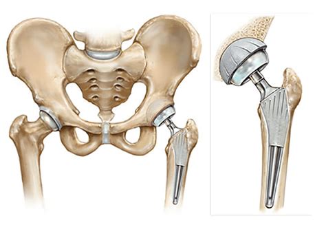 left total hip arthroplasty icd 10